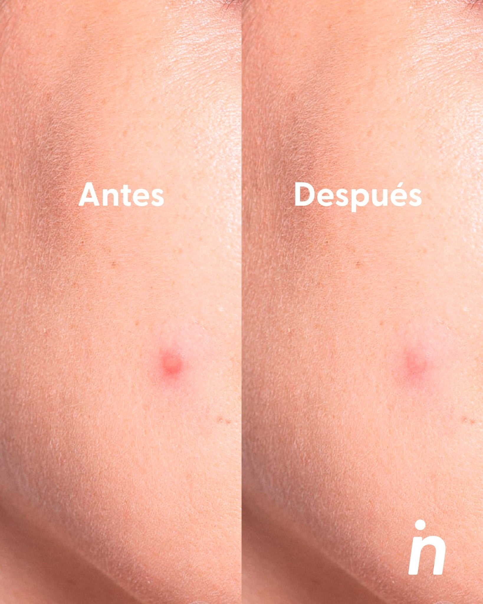 Parches con Ácido Salicílico x2 - Nipskin®