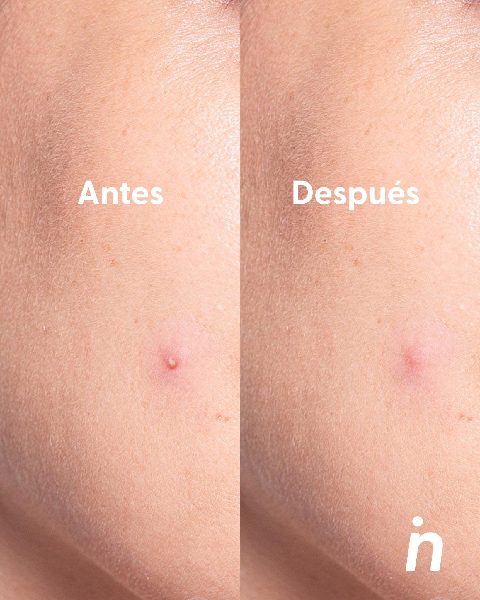 Parches de Hidrocoloide para Granitos - Nipskin®